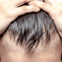 دلایل ریزش مو و درمان آن