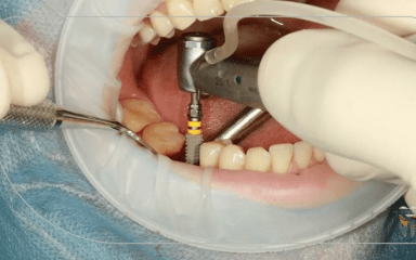 روش های مختلف جایگزینی دندان برای افرادی که هیچ دندانی ندارند